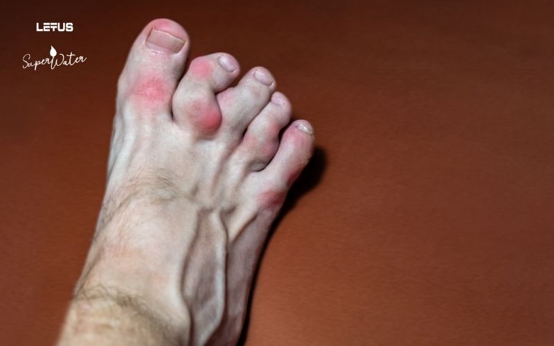 Causes of Gout and Effective Prevention and Treatment Methods