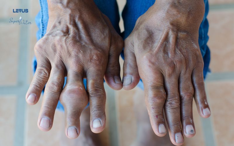 How Letus SuperWater Helps Alleviate Gout Pain